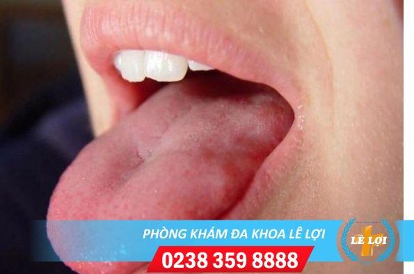 Nhận biết dấu hiệu sùi mào gà ở lưỡi