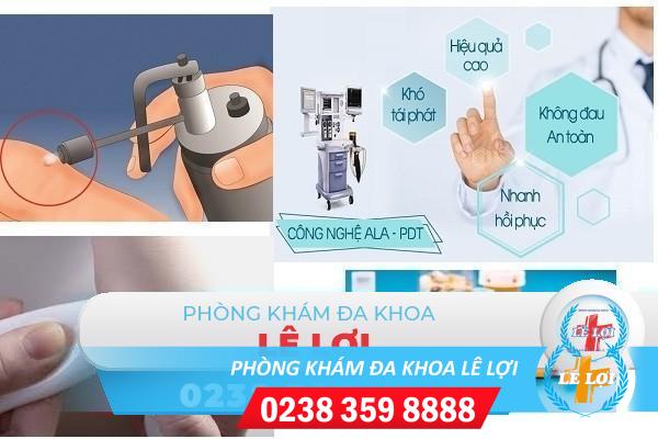 Điều trị sùi mào gà hiệu quả không tái phát