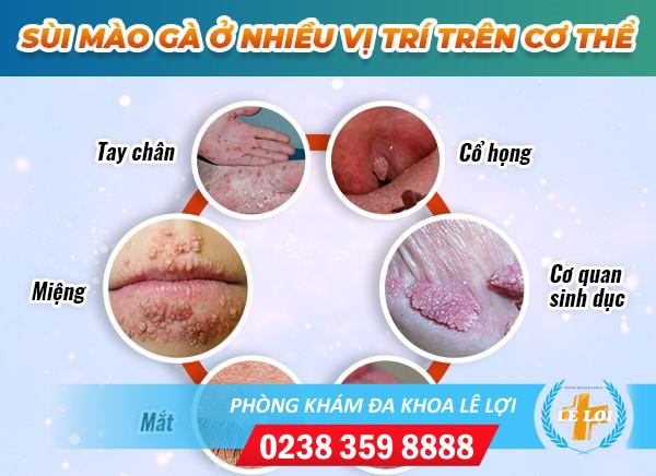 Phương pháp đốt sùi mào gà tại Phòng Khám Đa Khoa Lê Lợi