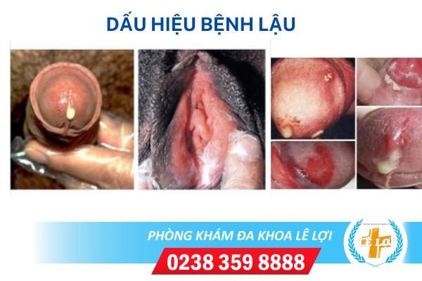 Địa chỉ chữa bệnh lậu hiệu quả tại Thành Phố Vinh, Nghệ An