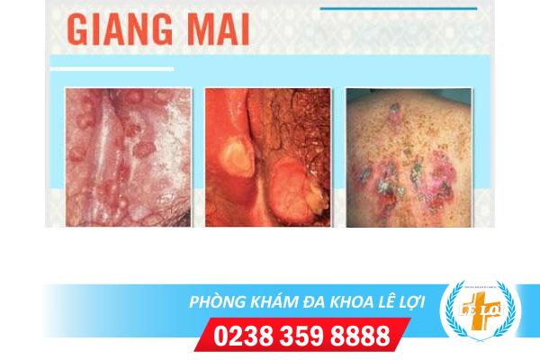 Địa chỉ điều trị giang mai sinh dục hiệu quả hiện nay