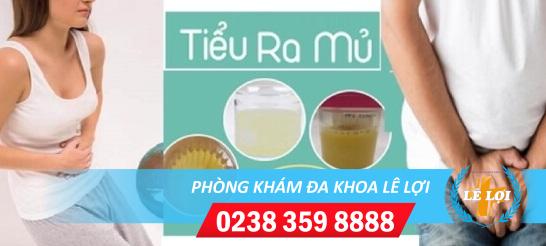 Tiểu có mủ là dấu hiệu của những bệnh gì?