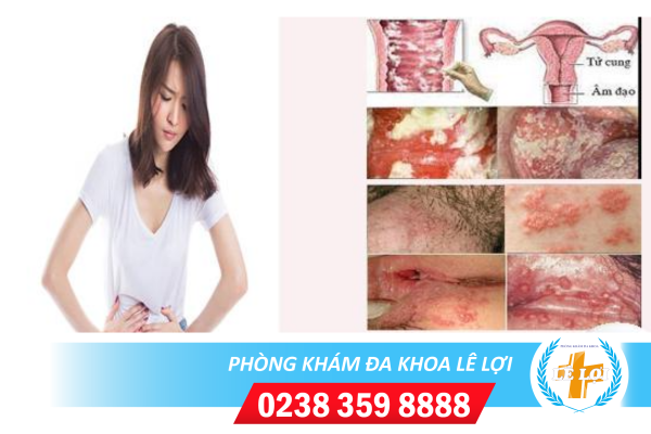 Đốm trắng vùng kín là bị bệnh gì?