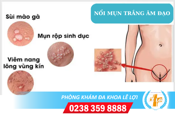 mụn trắng âm đạo