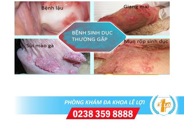 Các bệnh đường sinh dục thường gặp hiện nay