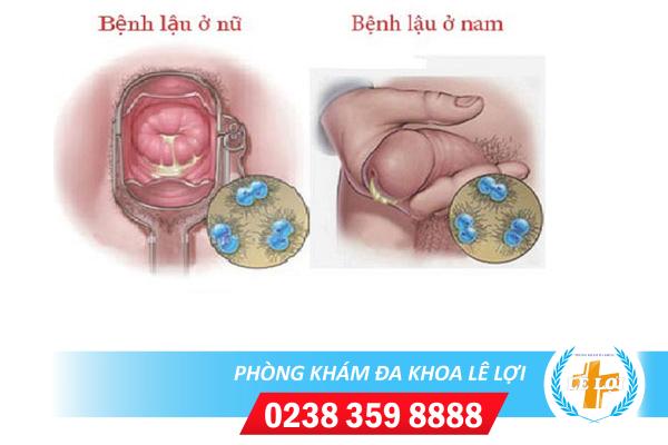 Bệnh lậu chữa được không?