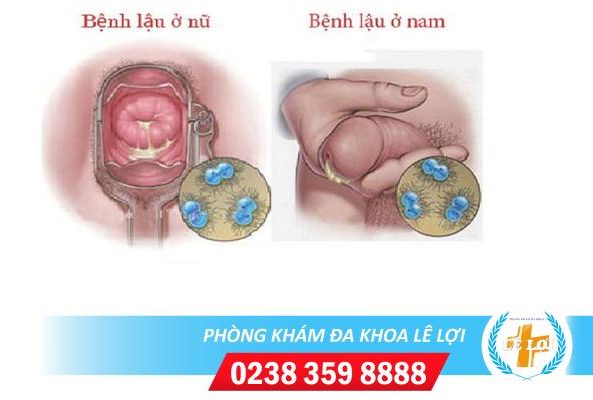 Nguyên nhân vùng kín chảy mủ và giải pháp điều trị