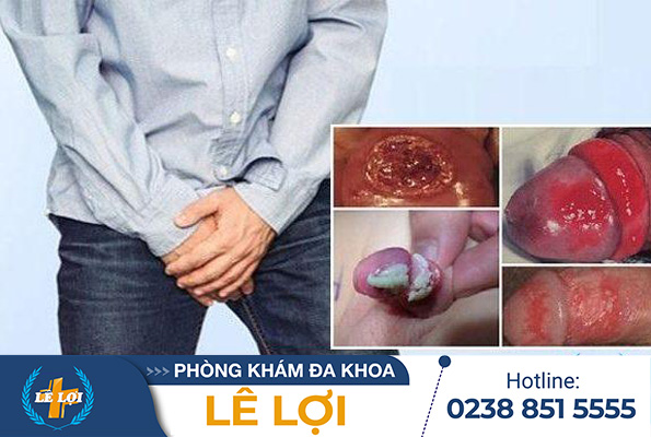 bieu-hien-viem-bao-quy-dau-e1713497066508