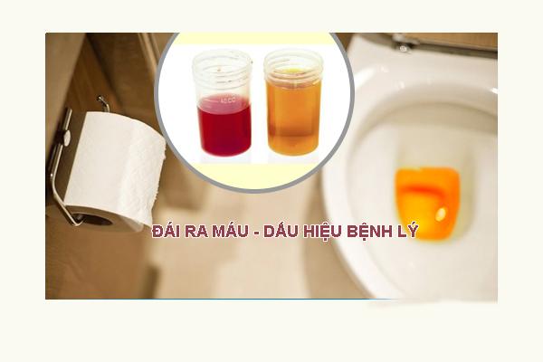 Điều trị đầu dương vật nổi mụn là bệnh gì?