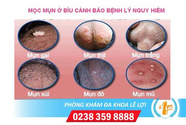 Nguyên nhân bị nổi mụn ở bìu là gì?