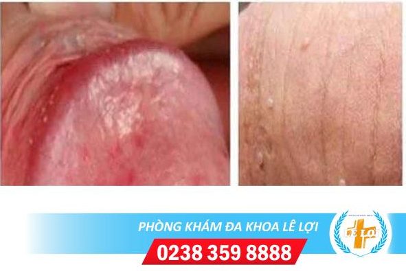 Nguyên nhân xuất hiện u nhú màu trắng đục