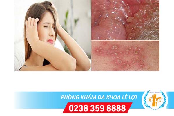 Nổi mụn âm hộ dấu hiệu bệnh xã hội chị em cần lưu ý