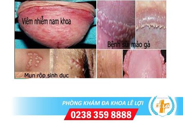 Nguyên nhân nổi mụn cậu bé phái mạnh nên biết