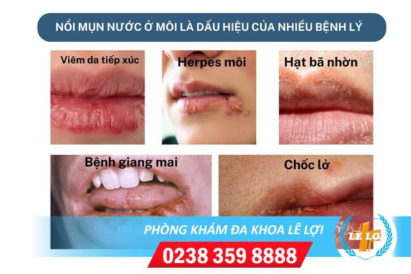 Điều trị nổi mụn nước ở môi như thế nào?