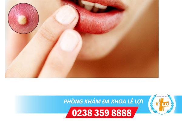 Địa chỉ điều trị nổi mụn trắng ở môi