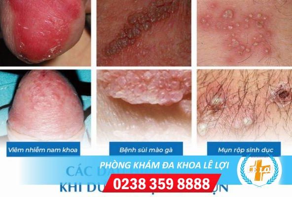 Những bệnh lý nguy hiểm của tình trạng nốt sần dương vật