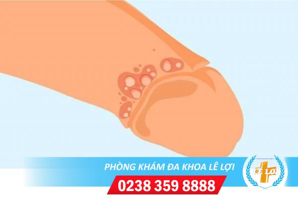 Mụn nhọt quy đầu và những nguyên nhân phổ biến