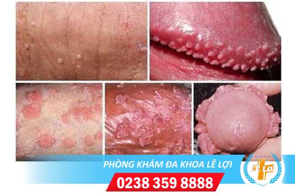 Nổi mụn cứng dương vật: Dấu hiệu bệnh nguy hiểm