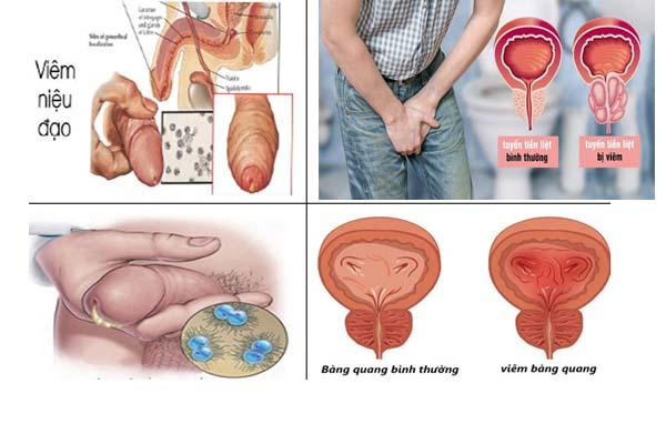 Nguyên nhân gây tiểu buốt và cách điều trị