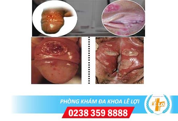 Nguyên nhân, dấu hiệu và cách điều trị bệnh hạ cam mềm