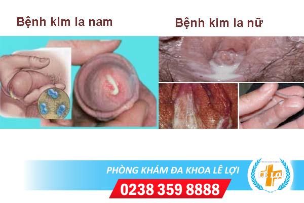 Bệnh kim la là gì? nguy hiểm không?