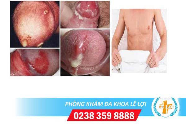 Dấu hiệu bệnh lậu cấp tính