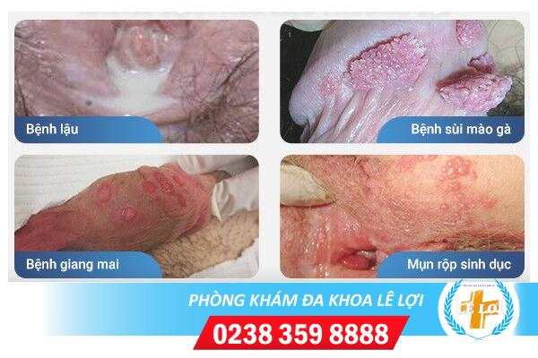 Dấu hiệu bệnh xã hội bạn nên biết sớm