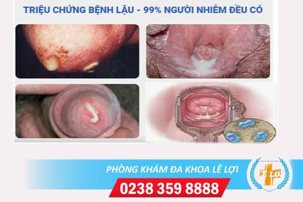 Chảy mủ sinh dục nguy hiểm không?