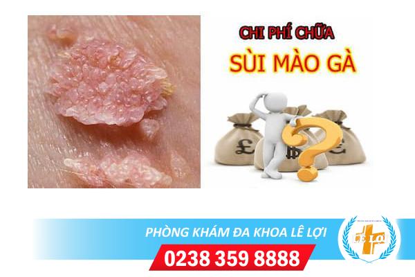 Chi phí chữa sùi mào gà ở nam bao nhiêu?