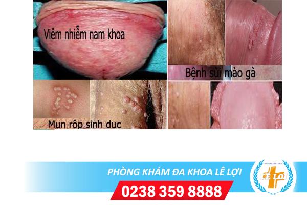 Đầu dương vật nổi mụn đỏ nguy hiểm không?