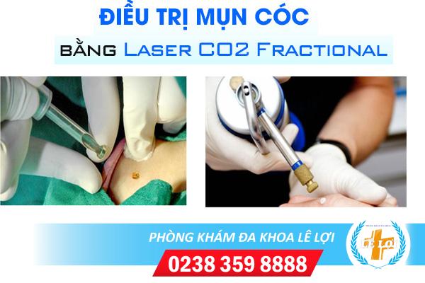 Đốt mụn cóc là gì hiệu quả không?