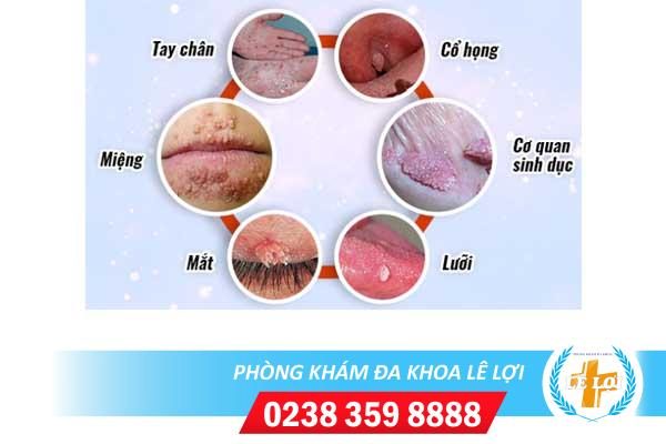 Hình ảnh sùi mào gà dấu hiệu bạn cần phát hiện sớm