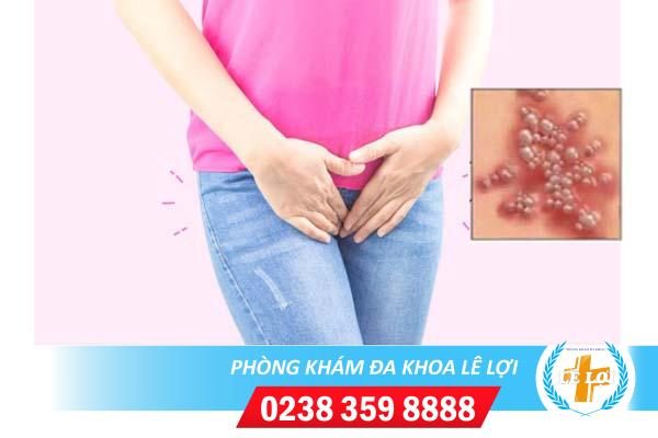 Cách trị mụn nước vùng kín hiện đại, nhanh khỏi