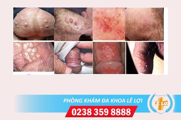 Mụn cóc sinh dục nam nguy hiểm không?