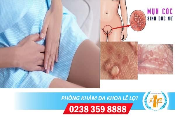 Mụn cóc sinh dục nữ là bệnh gì nguy hiểm không?