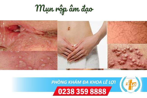 Dấu hiệu nhận biết mụn rộp ở âm đạo