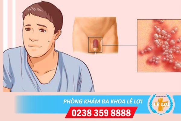 Cách điều trị mụn rộp sinh dục nam hiệu quả