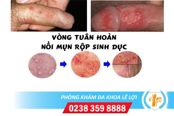 Dấu hiệu mụn rộp sinh dục thường gặp