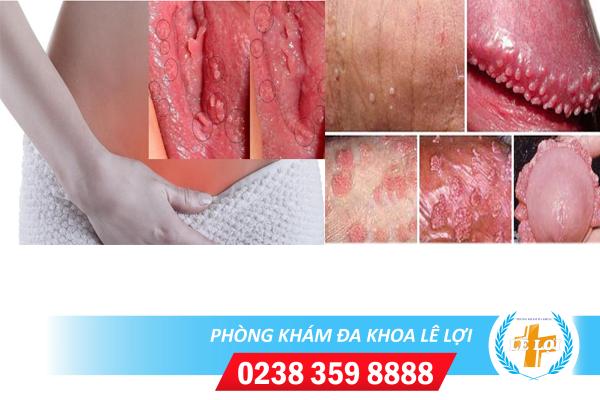 Mụn thịt vùng kín là bị bệnh gì?