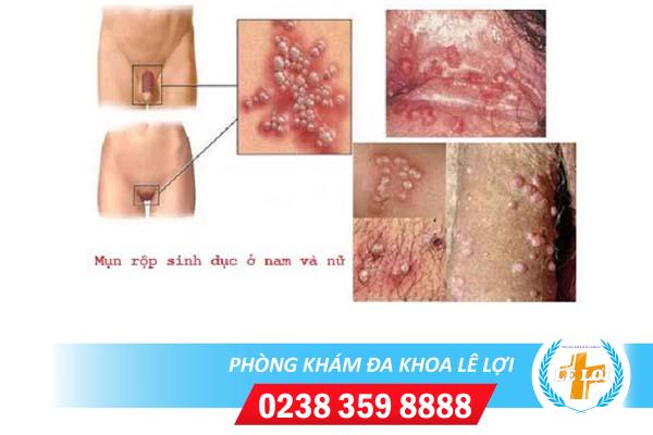 Nổi mụn trắng sinh dục nguy hiểm không?