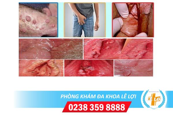 Dấu hiệu bệnh nấm mào gà