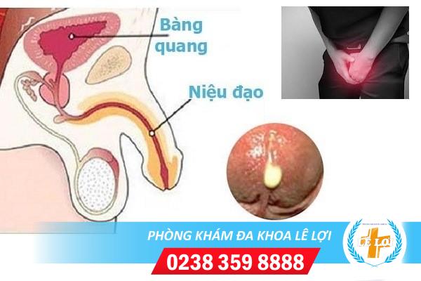 Niệu đạo chảy mủ là bị bệnh gì?