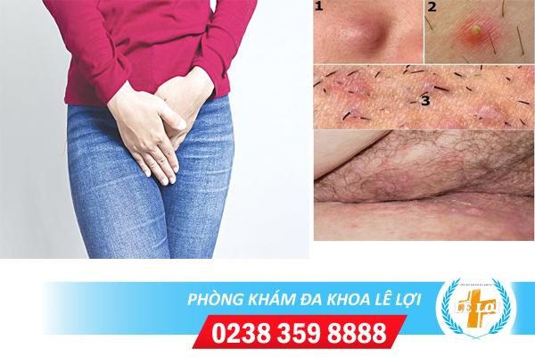 Nổi mụn âm vật là bệnh gì?