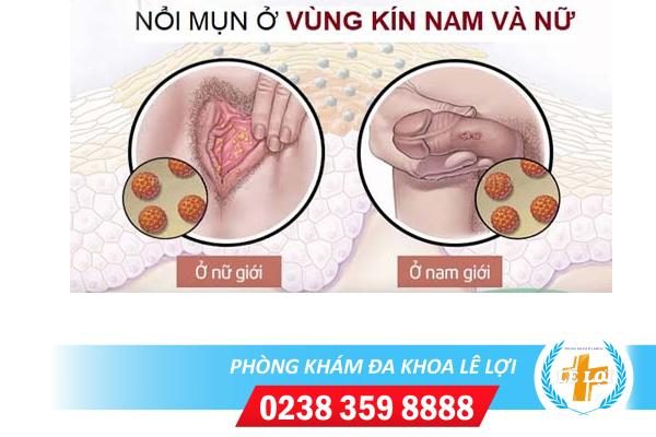 Cách trị mụn cứng vùng kín hiệu quả như ý