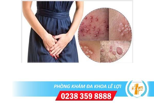 Nổi mụn trắng ở môi lớn môi bé là bị bệnh gì?