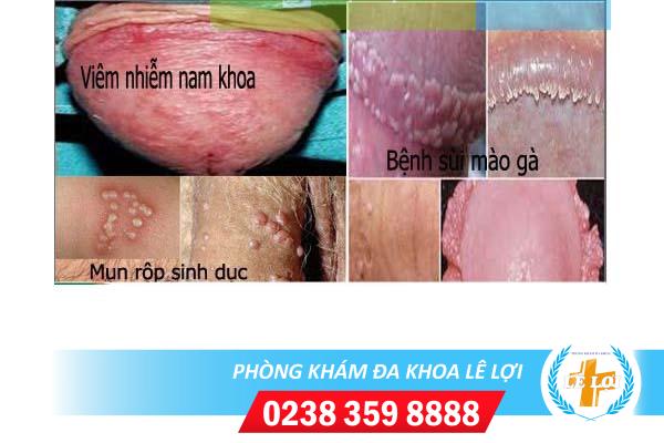 Nốt sần ở cậu nhỏ là bị bệnh gì?