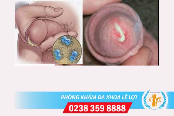 Quy đầu chảy mủ cảnh báo bệnh lý nguy hiểm