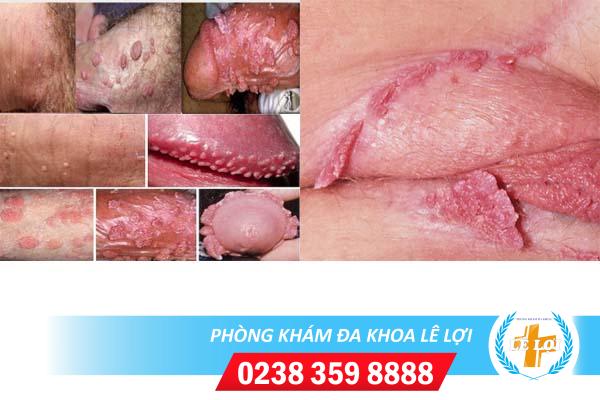 Sùi mào gà giai đoạn cuối nguy hiểm không?