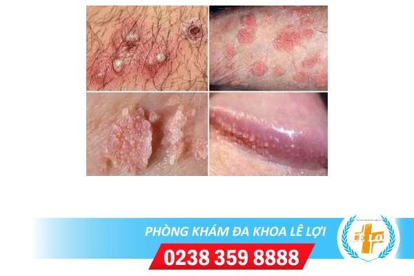 Mụn cóc ở chim là bị bệnh gì?