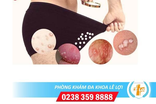 Nổi mụn trắng li ti dương vật phải làm sao?